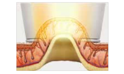 HSハンドピース 解説